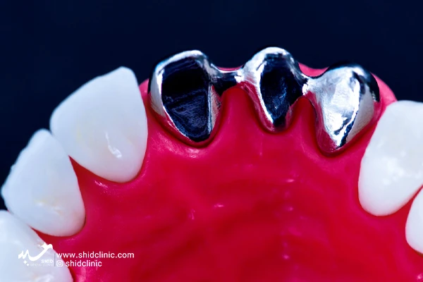 shid clinic dentures دندان دندانپزشکی زیبایی دندان مصنوعی پروتز ثابت دندان فلزی روکش pfm لثه ژله ای
