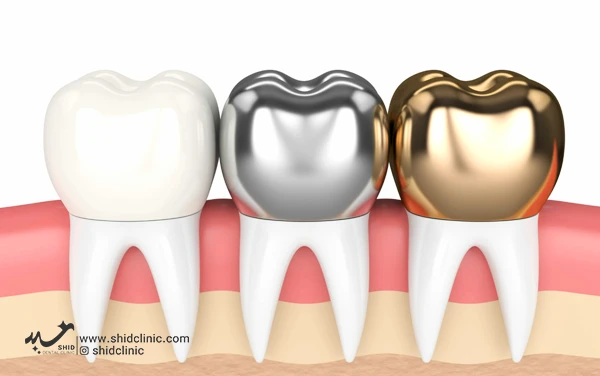 shid clinic dentures دندان دندانپزشکی زیبایی دندان مصنوعی پروتز ثابت دندان فلزی روکش pfm لثه ژله ای