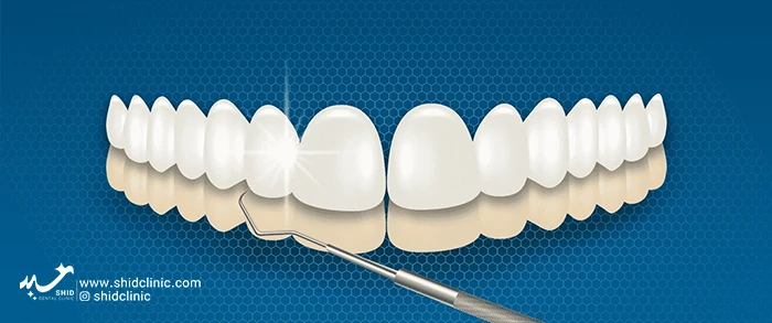 shid clinic لمینت دندانپزشکی زیبایی دندان مصنوعی