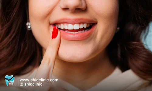 مقالات سایت کلینیک دندانپزشکی شید shid dental clinic articles blog
