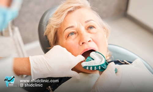 shidclinic-1-blog-article-فرآیند-9-مرحله-ای-در-دندان-مصنوعی
