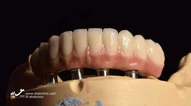 shidclinic blog-article- انتظارات از دندان مصنوعی