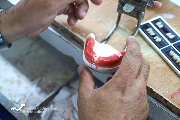 shidclinic-blog-articleفرآیند9مرحله ای در دندان مصنوعی کلینیک شید دندانپزشکی