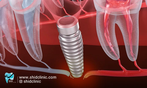 عفونت ایمپلنت آنچه باید بدانید کلینیک دندانپزشکی شید shid clinic شید کلینیک
