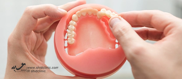 دندانسازی شید - بهترین برند دندان‌ مصنوعی shid clinic