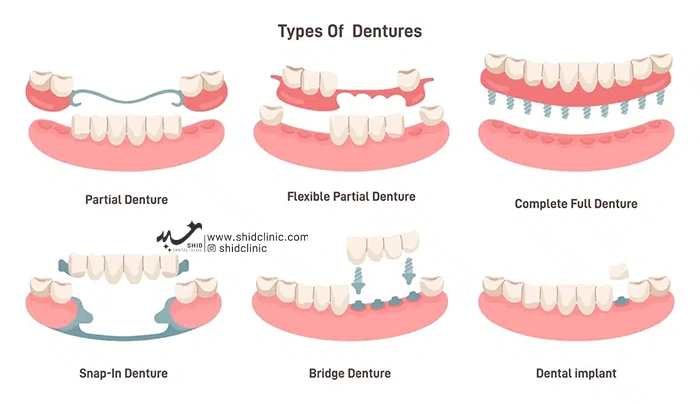 پروتزهای معمولی یا معایب دندان های مصنوعی