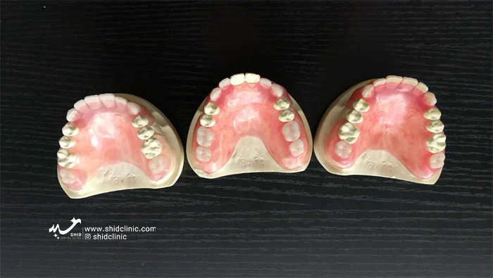 shidclinic-6پروتزهای فلکسیبل شید دندانسازی