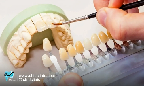 shidclinic-blog-articleدندانسازی-شید-لابراتوار