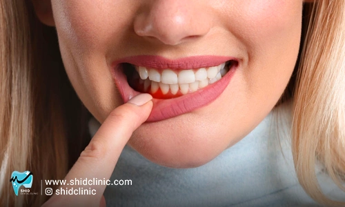 لثه نرم(پروتز فلکسی) قیمت مزایا و معایب آن