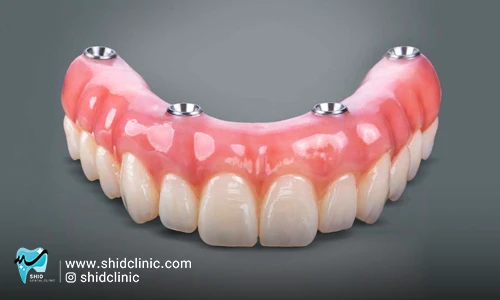 دندان مصنوعی بدون سقف