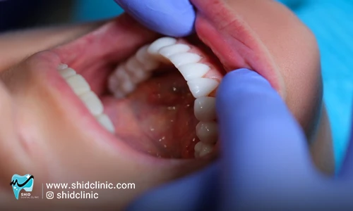 مشکل صحبت با دندان مصنوعی+راهکار حل مشکل