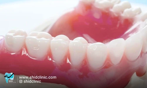 قیمت دندان مصنوعی ایتالیایی پلی دنت (polident)