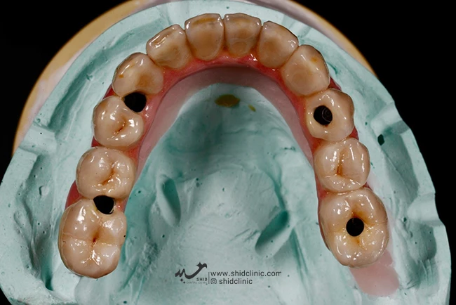 همه چیز در مورد دندان مصنوعی هیبرید