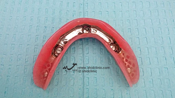 معایب دندان مصنوعی بدون سقف فک بالا