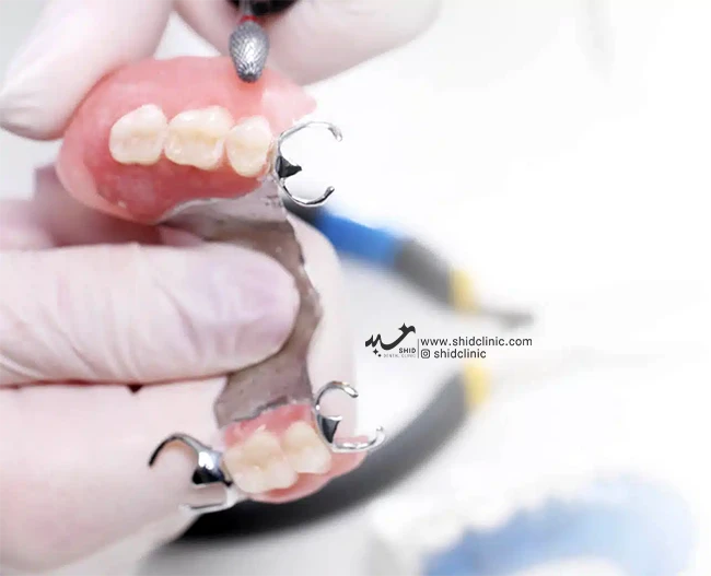 پروتزهای تکه‌ای شفاف: راهی نوین در دندانپزشکی