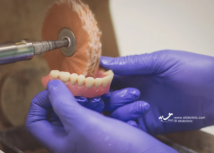 مراحل تعمیر دندان مصنوعی در لابراتوار شید