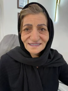 دست دندان کامل بالا و پایین دندان سوئیسی