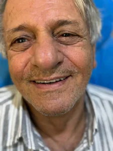 دندان مصنوعی کامل فک بالا ژله ای یا فلکسی