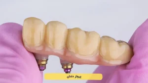 دندان مصنوعی (پروتز دندان) چیست و چه تفاوتی با ایمپلنت دارد؟
