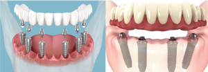 تفاوت اوردنچر با ایمپلنت دندان چیست؟
