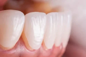 لمینت دندان بهتر است یا کامپوزیت؟
